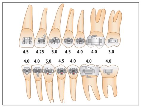 metal bracket gauges|roth bracket positioning chart.